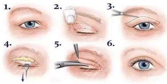最新双眼皮手术技术发展与患者体验分享